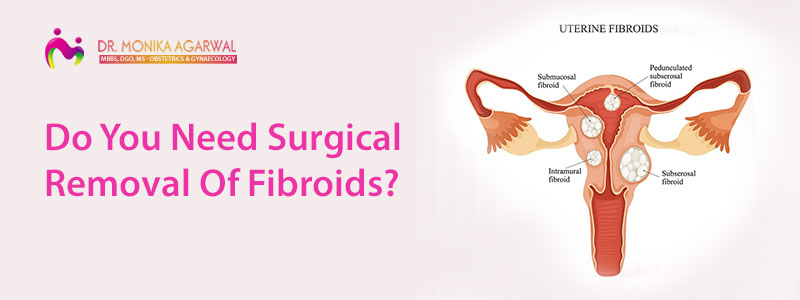 Do You Need Surgical Removal Of Fibroids